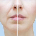 филлеры в носогубки