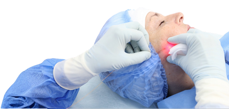 Ендоліфт процедура