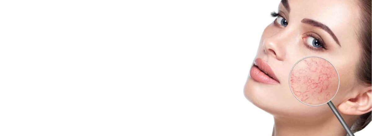 сосудистые звездочки клиника