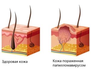 структура бородавки