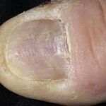 ногти дерматолог