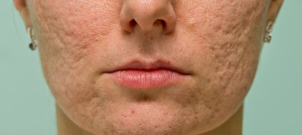 Post acne