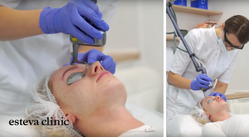 Laser resurfacing with a CO2 laser Esteva Clinic