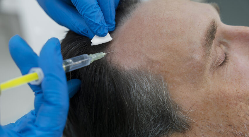 Hair mesotherapy