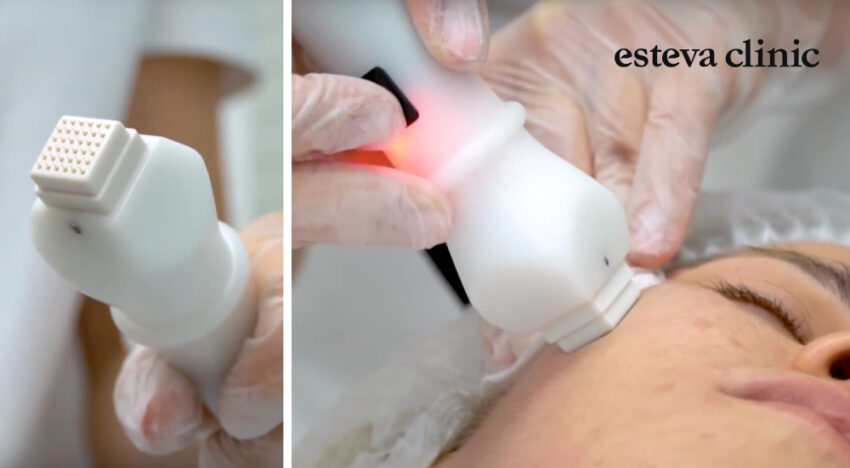 Microneedle RF lifting Esteva Clinic