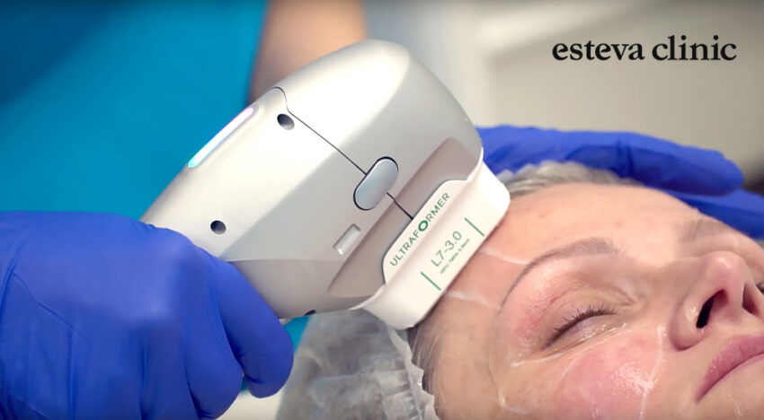 Ultrasonic SMAS lifting in Esteva Clinic