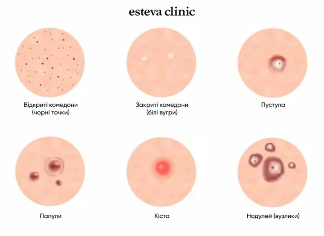 Виды высыпаний и проблем кожи при акне