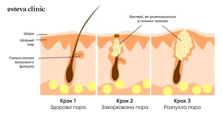 Causes of acne