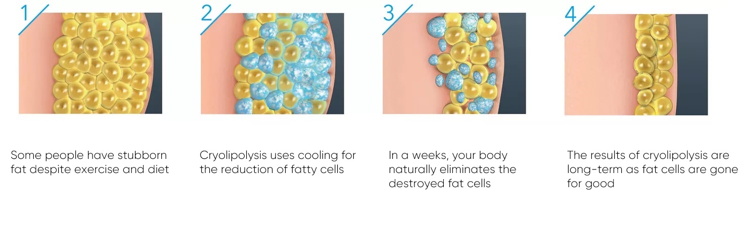 cryolipolysis kyiv