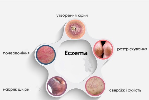 екзема симптоми