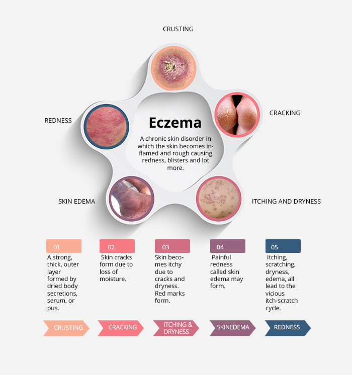 eczema symptomatics