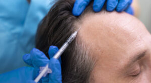 Мезотерапия для волос мужчин