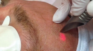 Laser resurfacing for man