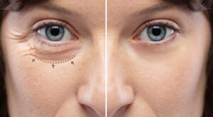 Remove bags under the eyes in Esteva Clinic