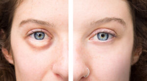 Remove bags under the eyes in Esteva Clinic