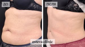 Cryolipolysis in Esteva Clinic