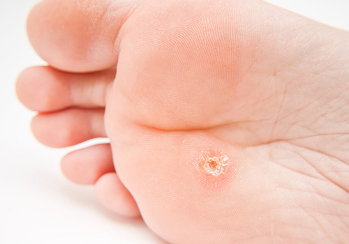 Plantar wart