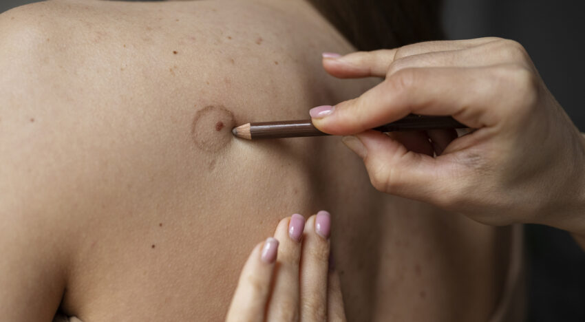 Removing moles in Esteva Clinic