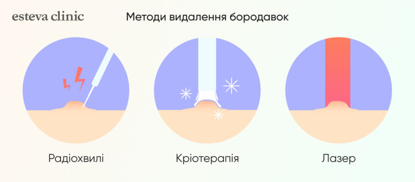 Методи видалення бородавок