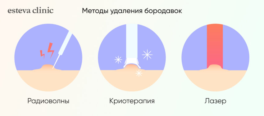 Методы удаления бородавок