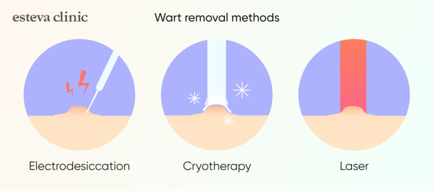 How to remove warts in a modern cosmetology clinic