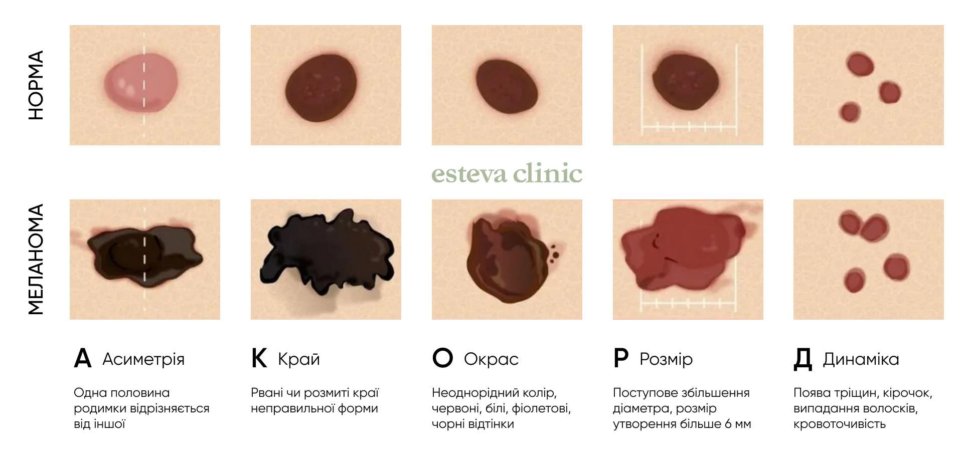 ABCDE mole characteristics