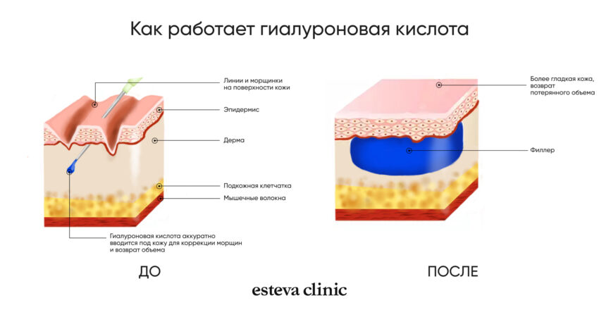 Контурная пластика скул