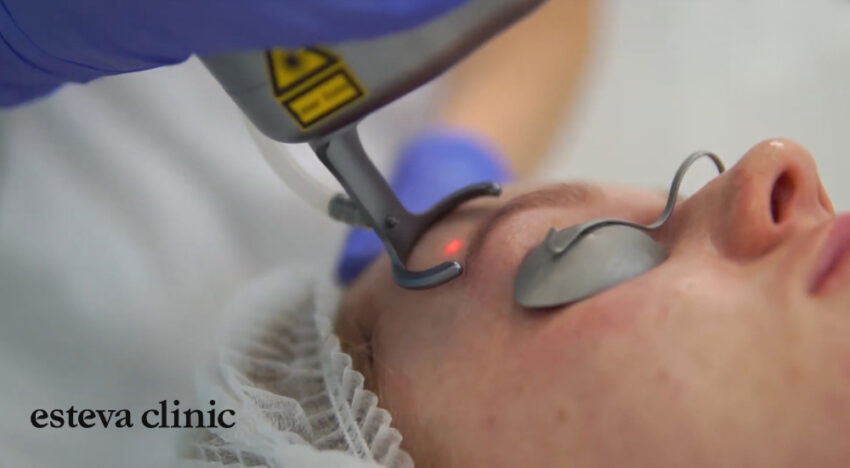 Eyelid rejuvenation without surgery