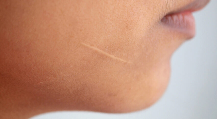Прибрати шрами – лікування та методи