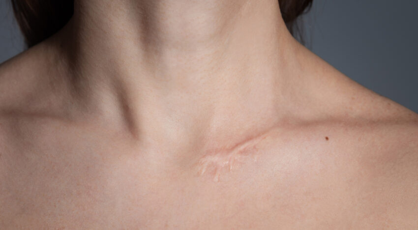 Прибрати шрами – лікування та методи