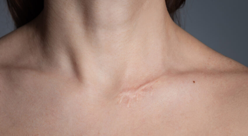 Remove a scar with a laser - remove a scar in Kyiv quickly - Esteva Clinic