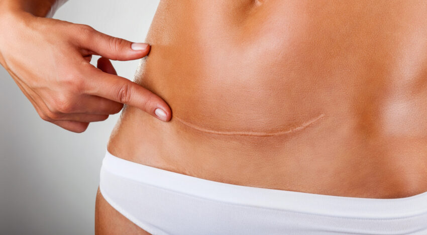 Remove scars - treatment and methods