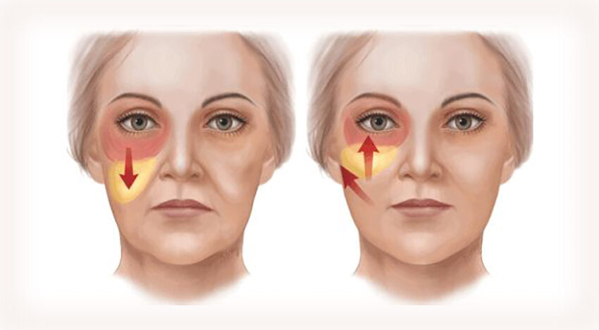 Gravitational ptosis of the face