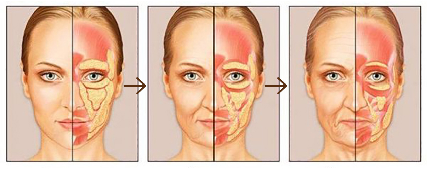 Gravitational ptosis of the face