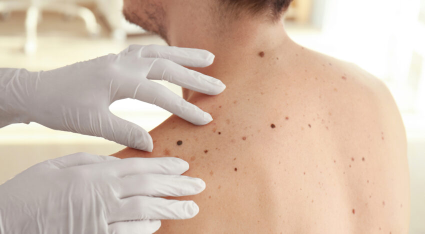 Is a histology necessary before removing moles?