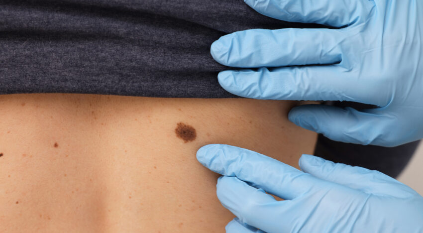 Is a histology necessary before removing moles?
