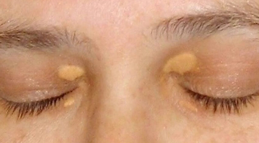 Xanthelasma laser removal