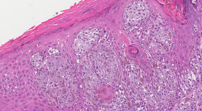 Is a histology necessary before removing moles?