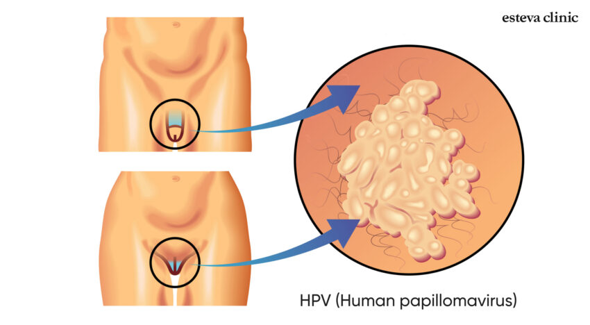 Genital papillomas