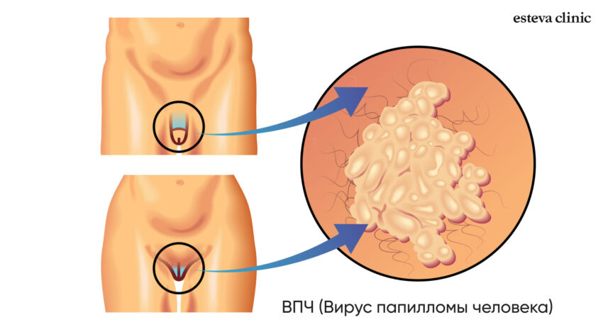 Папилломы на гениталиях