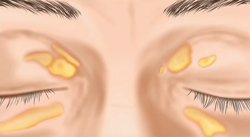 Xanthelasma laser removal