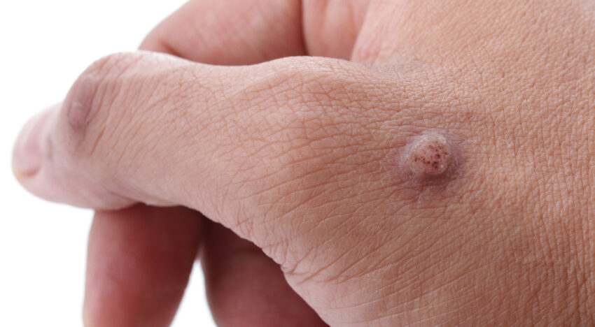 How to remove a wart